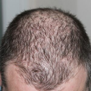 La perdida de cabello en hombres