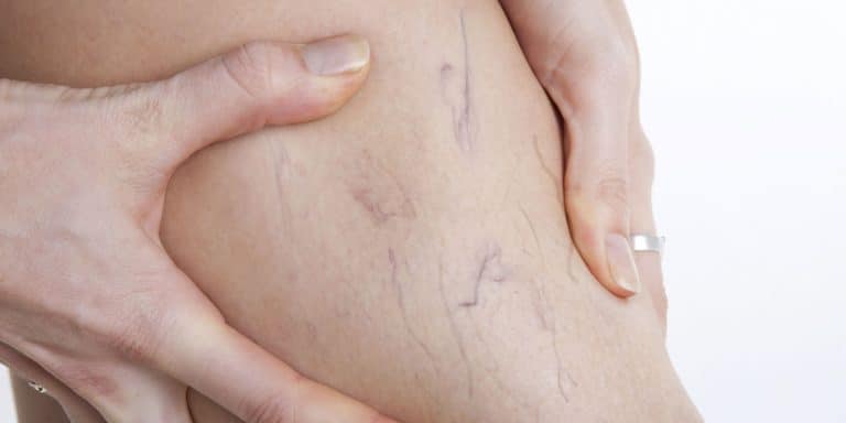Conoce las venas varicosas