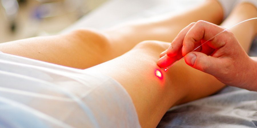 láser para venas varicosas