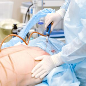 riesgos de la liposucción